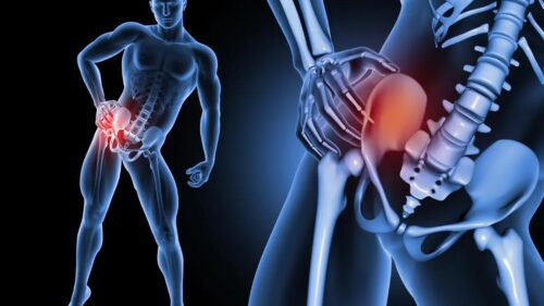 Sclerosi del tetto acetabolare - Orthocare STP