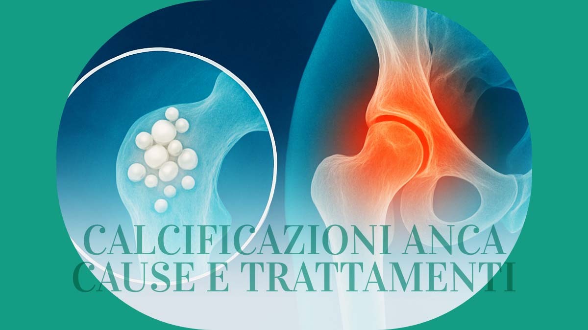 Calcificazioni Anca