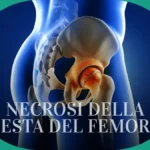 Necrosi della testa del femore