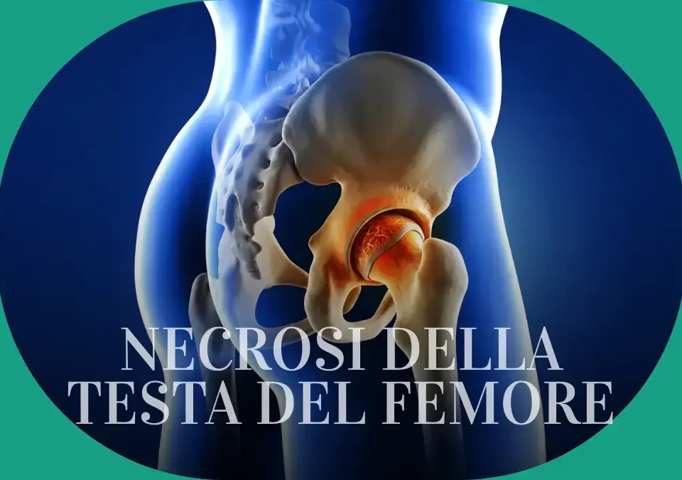 Necrosi della testa del femore